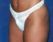 Tummy Tuck 13 After 2