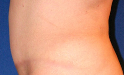 Tummy Tuck 03 After 2