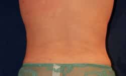 Liposuction 01 After