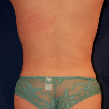 Liposuction 01 After 1