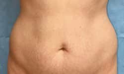 Liposuction 04 Before