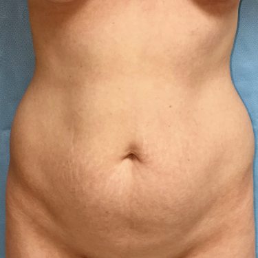 Liposuction 04 Before 1