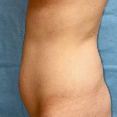 Liposuction 04 Before 2