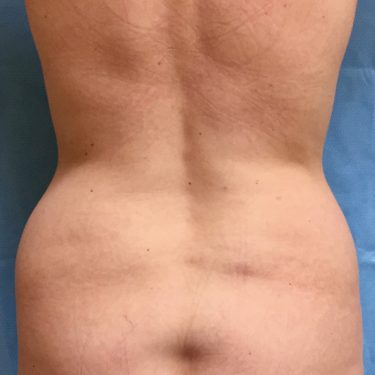 Liposuction 04 Before 3