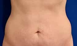 Liposuction 04 After