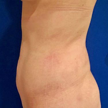 Liposuction 04 After 2