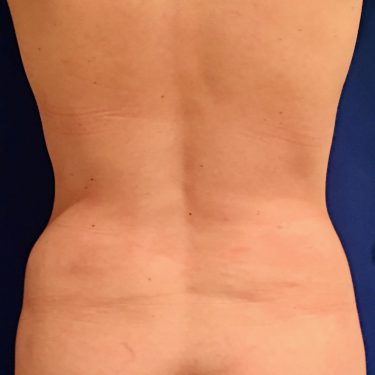 Liposuction 04 After 3