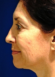 Facelift 03 Before 3