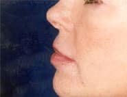 Lip Lift / Augmentation 02 After 2