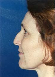 Brow Lift 01 Before 3