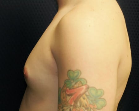 Gynecomastia 01 Before 1