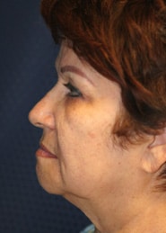 Facelift 04 Before 3