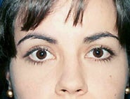 Eyelid Surgery 13 After 1