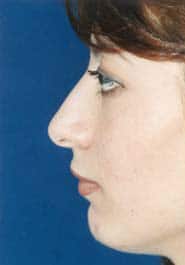 Rhinoplasty 03 Before 3
