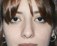 Rhinoplasty 03 Before