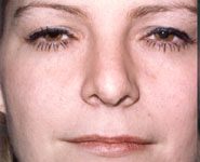 Rhinoplasty 06 Before