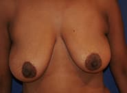Breast Lift 02 Before 1