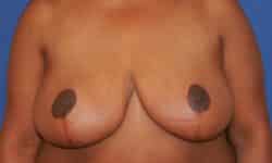 Breast Reduction 03 After
