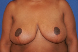 Breast Reduction 03 After 1
