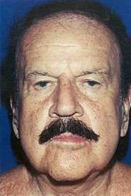 Neck Lift 03 After 1