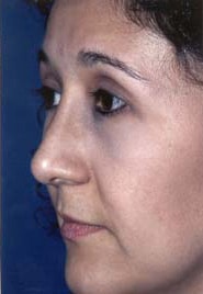 Rhinoplasty 02 After 2