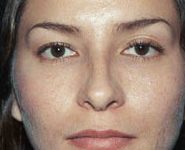 Rhinoplasty 09 After