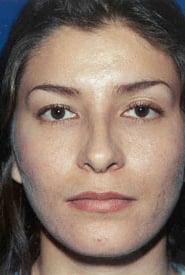 Rhinoplasty 09 After 1