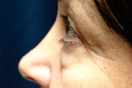 Eyelid Surgery 02 Before 3