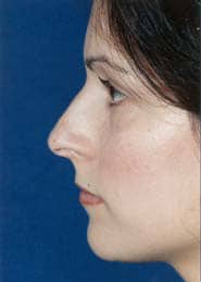 Rhinoplasty 04 Before 2