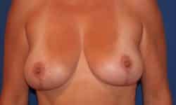 Breast Lift 01 After