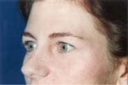 Brow Lift 02 Before 2