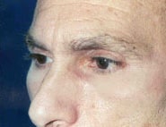 Eyelid Surgery 10 After 2