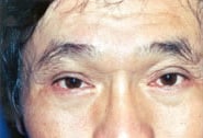 Eyelid Surgery 09 After 1