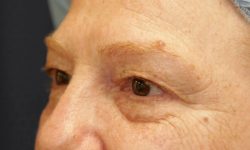 Eyelid Surgery 01 Before