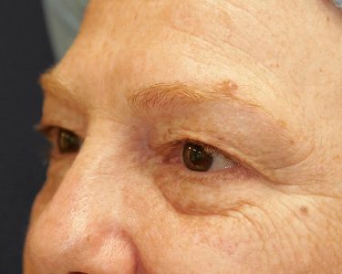 Eyelid Surgery 01 Before 1