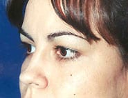 Eyelid Surgery 13 Before 2