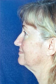 Neck Lift 04 Before 3
