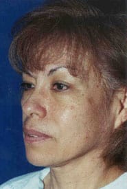 Facelift 11 Before 2