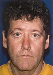 Facelift 08 Before 1