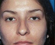 Rhinoplasty 09 Before