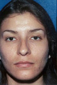 Rhinoplasty 09 Before 1