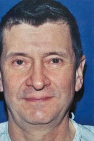 Facelift 10 Before 1