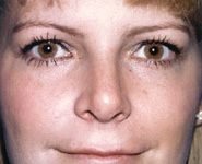 Rhinoplasty 06 After