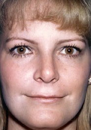 Rhinoplasty 06 After 1