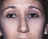 Rhinoplasty 02 After