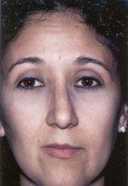 Rhinoplasty 02 After 1