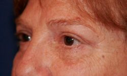 Eyelid Surgery 01 After