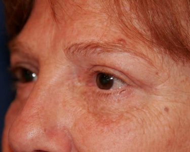 Eyelid Surgery 01 After 1