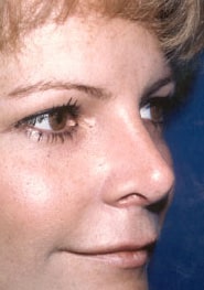 Rhinoplasty 06 After 2