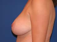 Breast Lift 04 After 3